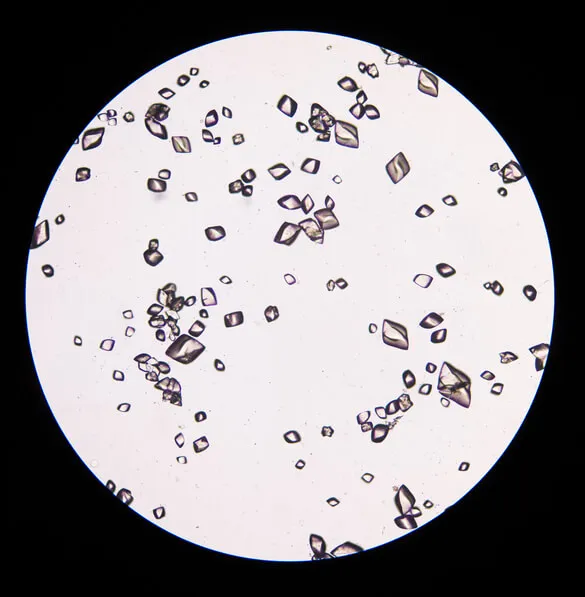 Cálculos de ácido úrico — o que fazer nos casos refratários?