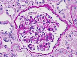Importância de tratar a Nefropatia por IgA cedo – principal aprendizado do KDIGO 2025