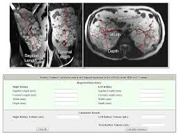 Classificação da Mayo Clinic na Doença Renal Policística: como fazer e aplicar na prática clínica?”